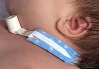 kind en trachea canule